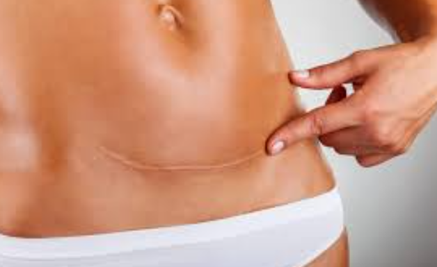 Cesarean Section in Chennai S A Hospital Expert Su... main image