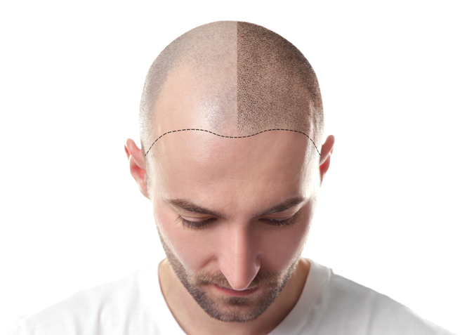 Transform Your Look with Hair Plugs at Eloraa clin... main image