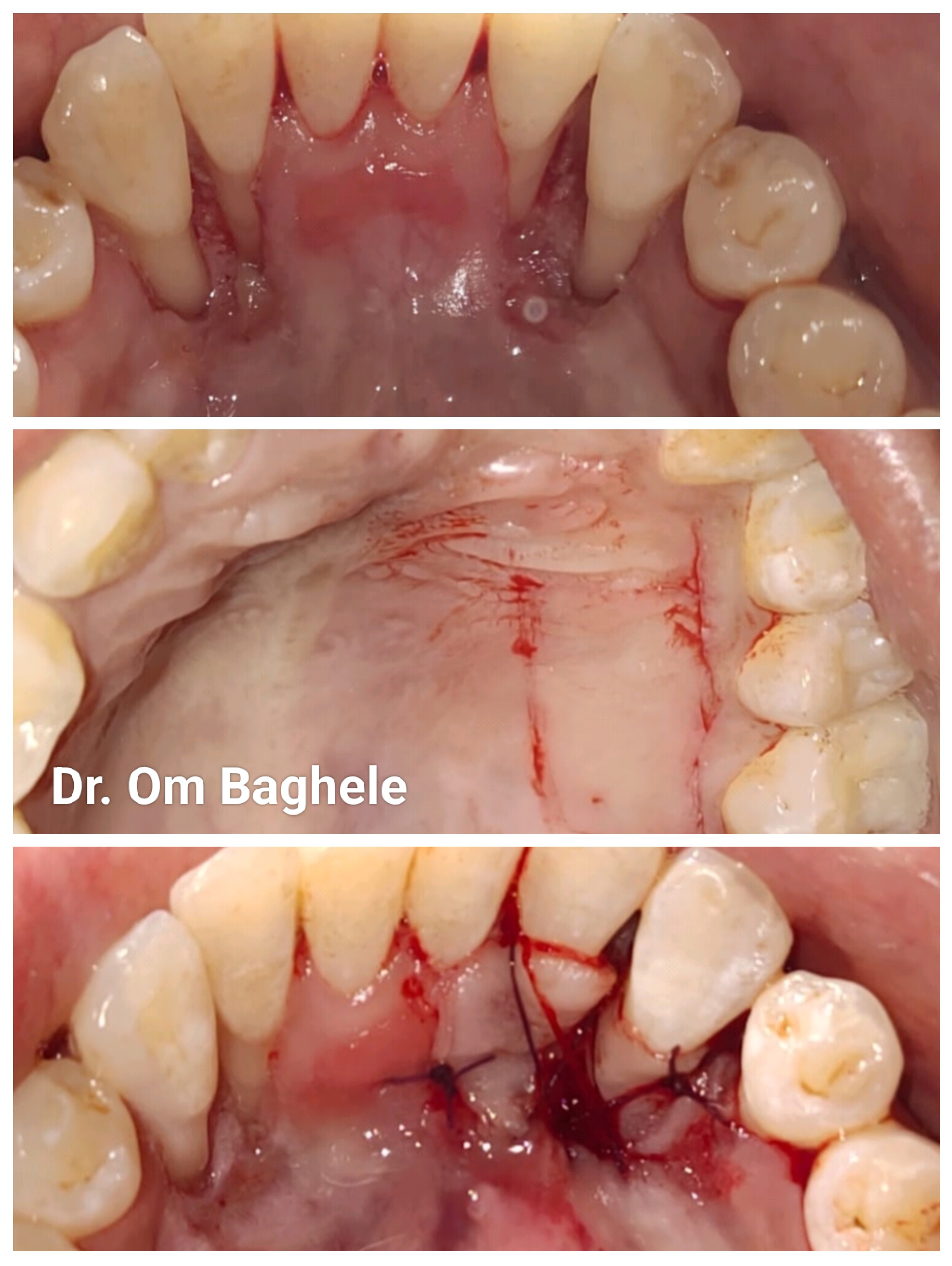 Periodontal plastic surgery on the lingual side... main image