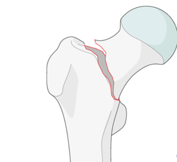 Specialized Neck of Femur Fracture Treatment at KC... main image