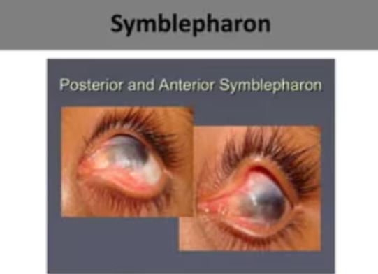 Symblepharon Care at Green City Eye Clinic, Nag... main image