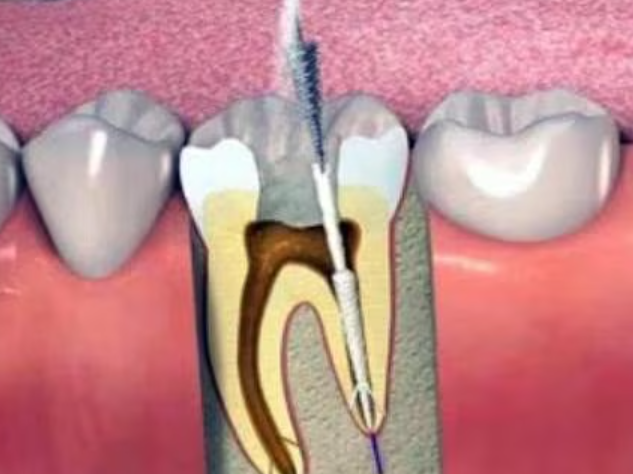 Root Canal Treatment: Save Your Tooth and Relieve ... main image