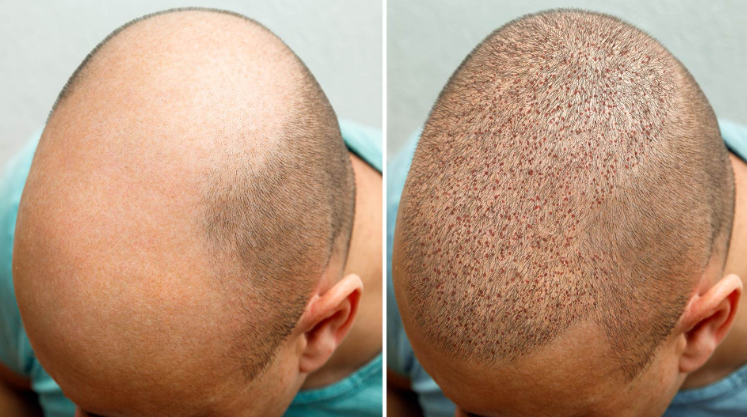 The Best Hair Transplant in Chennai: Why Choose... main image