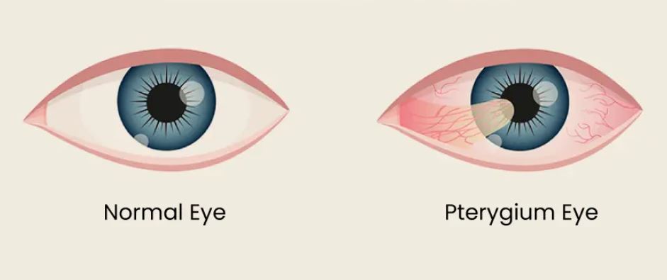 Pterygium Management at Green City Eye Clinic, ... main image
