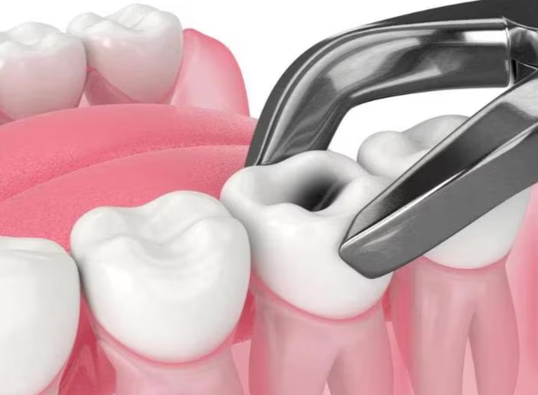 Tooth Extraction Procedure: Safe and Comfortable S... main image