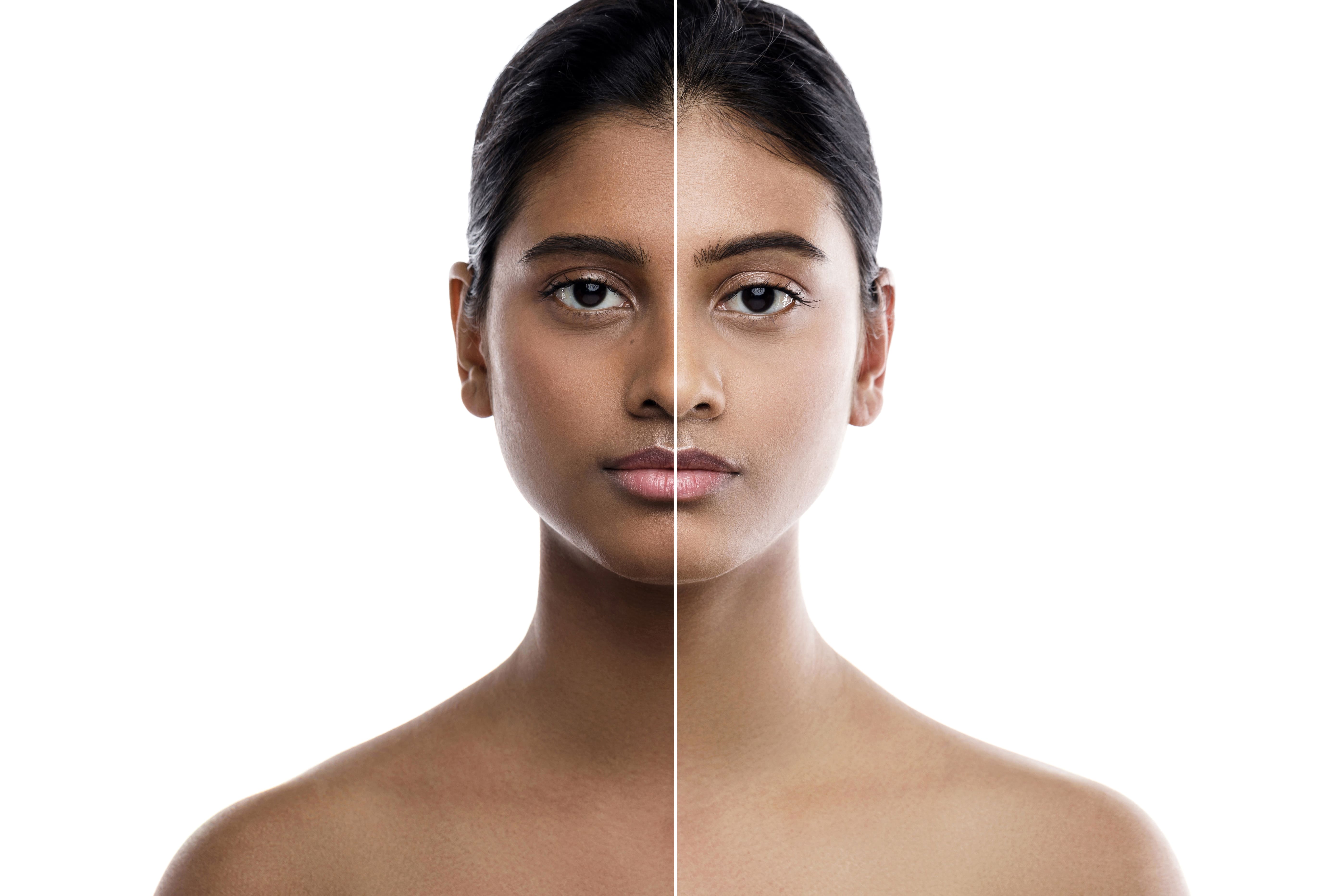 SKIN LIGHTENING TREATMENT AT ELORRA @ VADAPALANI T... main image