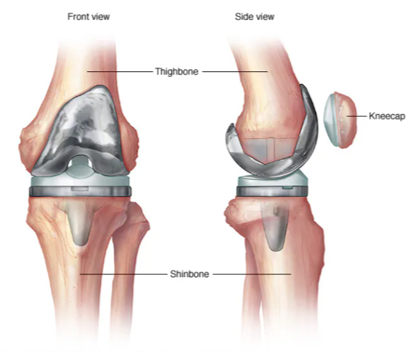 Advanced Knee Replacement Surgery at KC Hospital i... main image