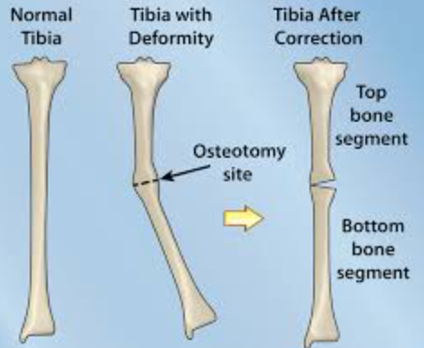 Deformity Correction in Jaipur Bone deformities... main image