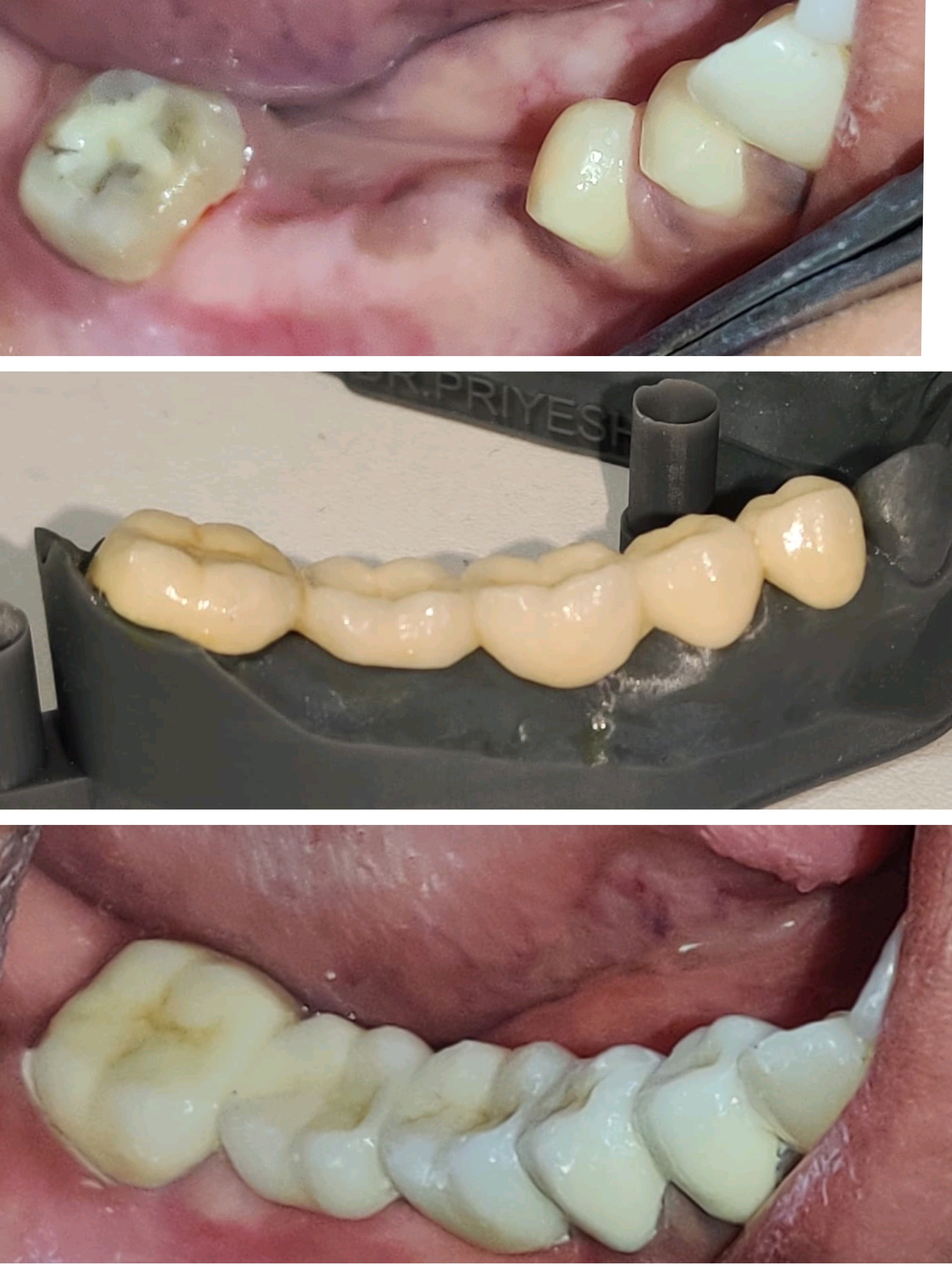 ceramic bridge to restore bite and tooth to mak... main image