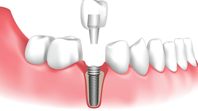 Dental Implant Surgery: Restore Your Smile with Co... main image
