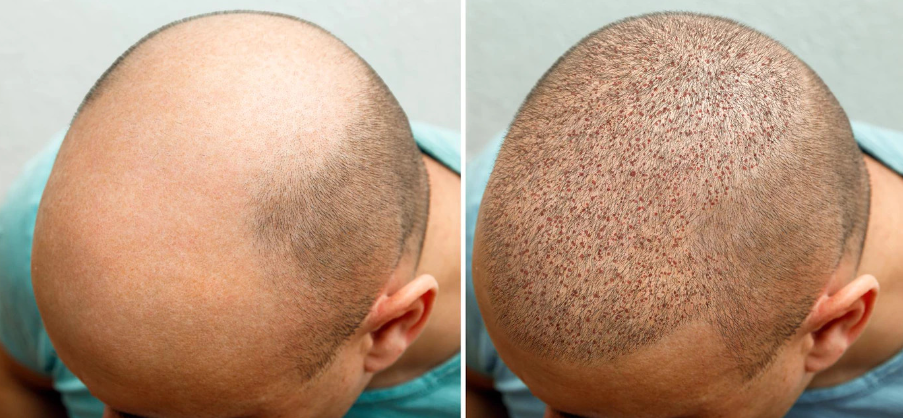 FUE Hair Transplant: A Leading Method at ELORAA... main image