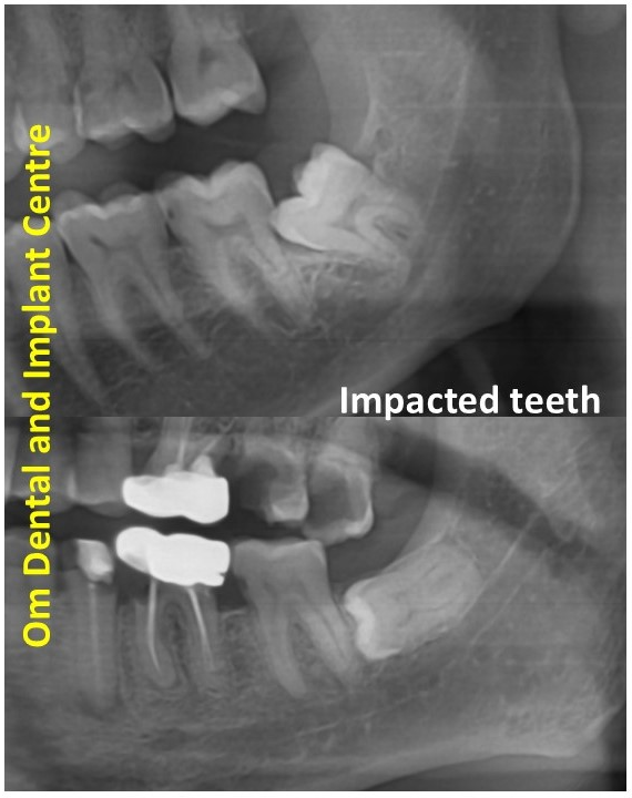 Impacted teeth are the ones who fail to erupt p... main image