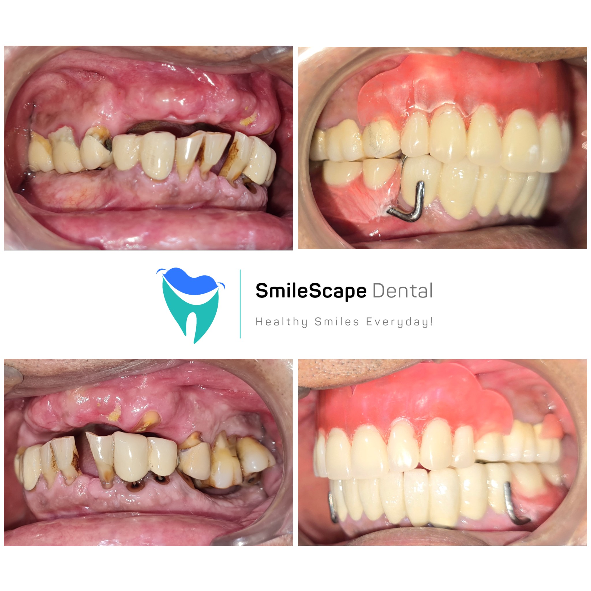Missing teeth has a negative impact on digestio... main image