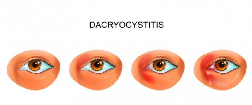 Dacryocystitis Solutions in Nagpur Green City E... main image