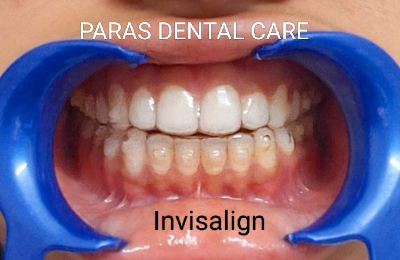 🌟 Transform Your Smile with Invisalign at Paras... main image