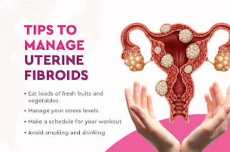 Effective Tips to Manage Uterine Fibroids: Advi... main image
