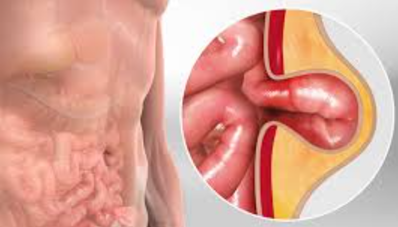 Hernia Surgery in Bhayandar Dr. Rajiv Manek Her... main image