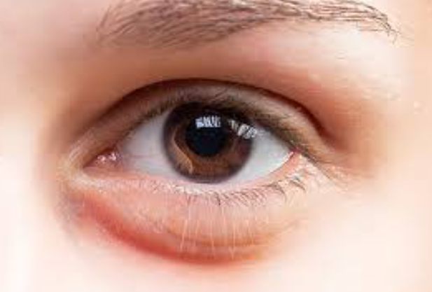 Swelling in Retina Treatment Isha Netralaya, Th... main image