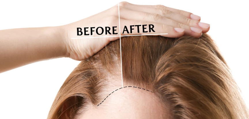 Hair Implant Solutions for Women: ELORAA CLINIQ... main image