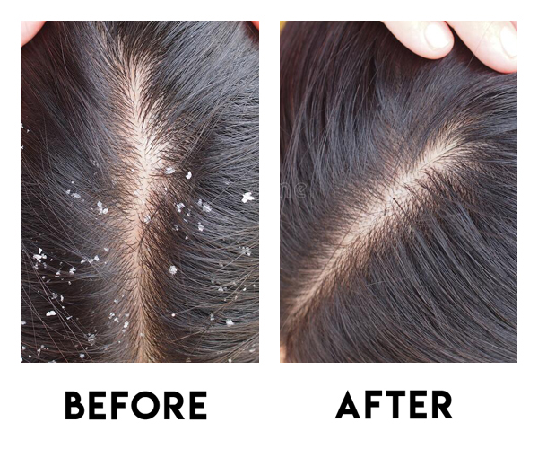 DANDRUFF TREATMENT AT ELORAA High-frequency tre... main image