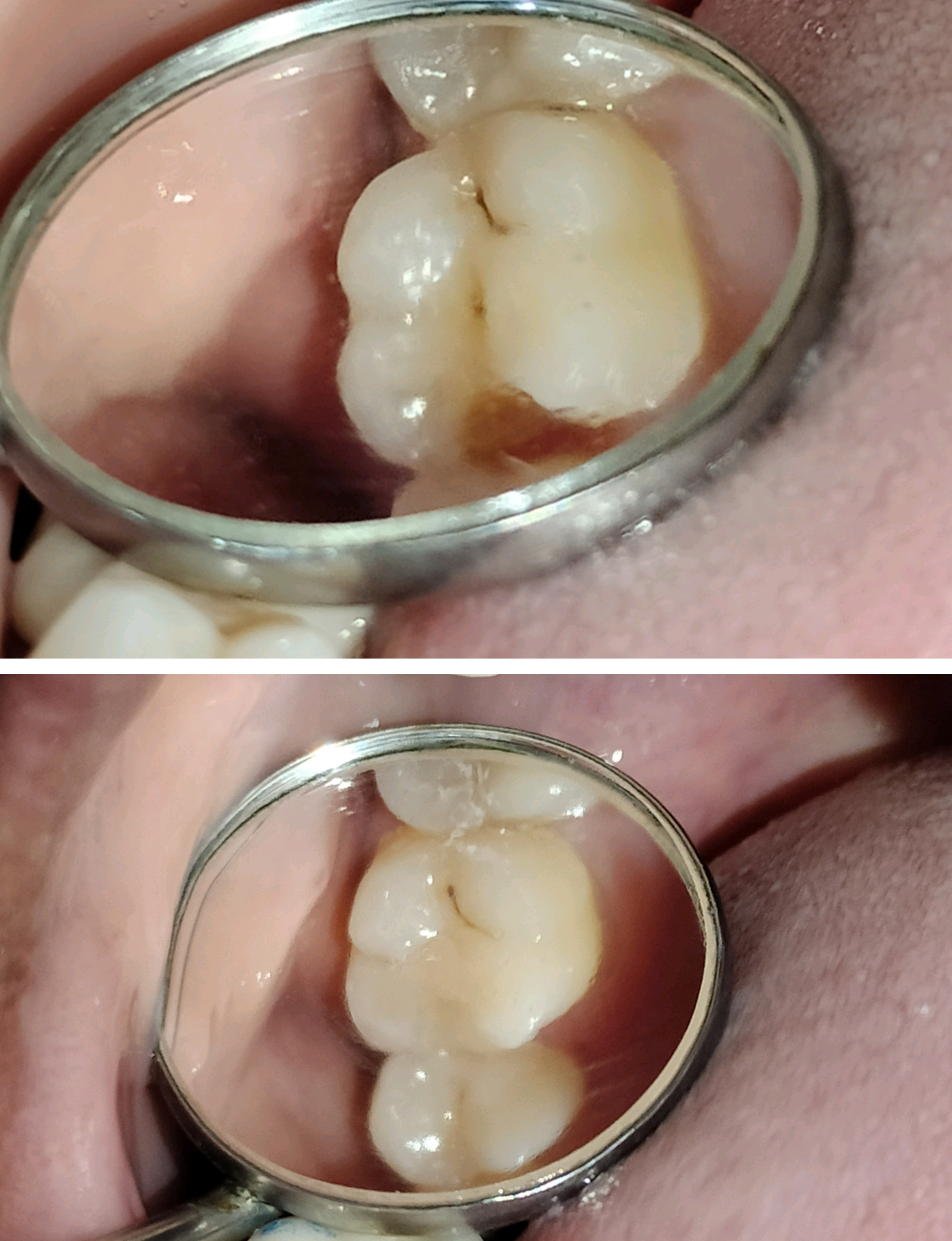 decayed tooth but don't want people to know? we... main image
