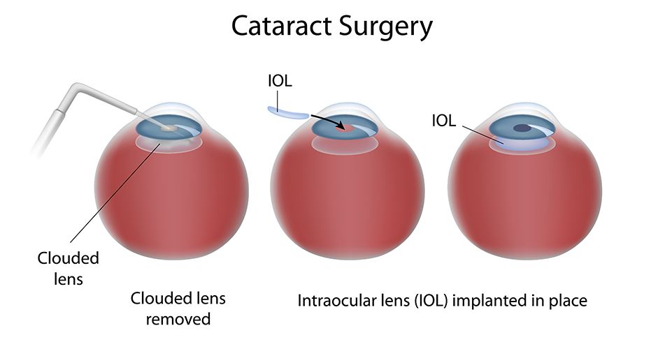 Cataract Surgery in Nagpur: Restoring Clear Vis... main image