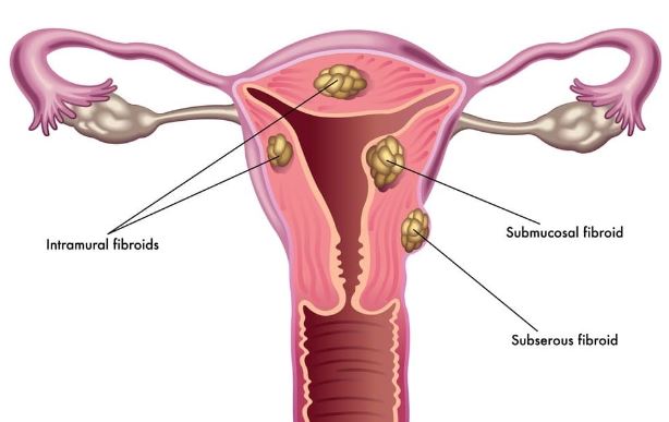 Fibroid Uterus Treatment in Nagpur Fibroids are... main image
