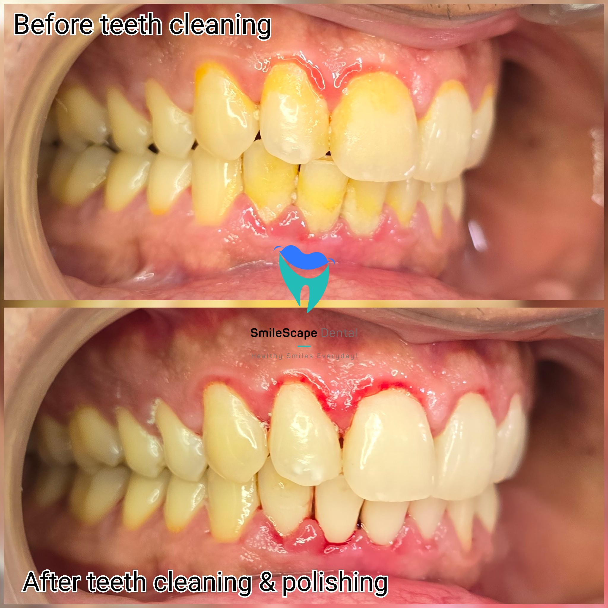 Dirty or unclean teeth contain food debris that... main image