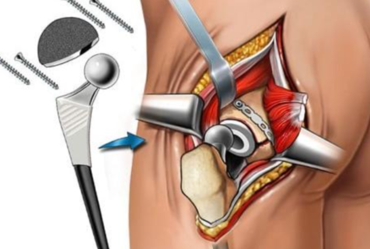 Advanced Hip Replacement Surgery in Avadi Hip repl... main image