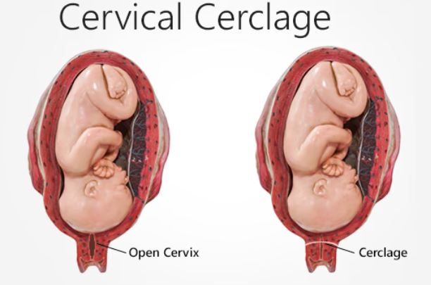 Cervical Cerclage in Nagpur – Safe and Effectiv... main image