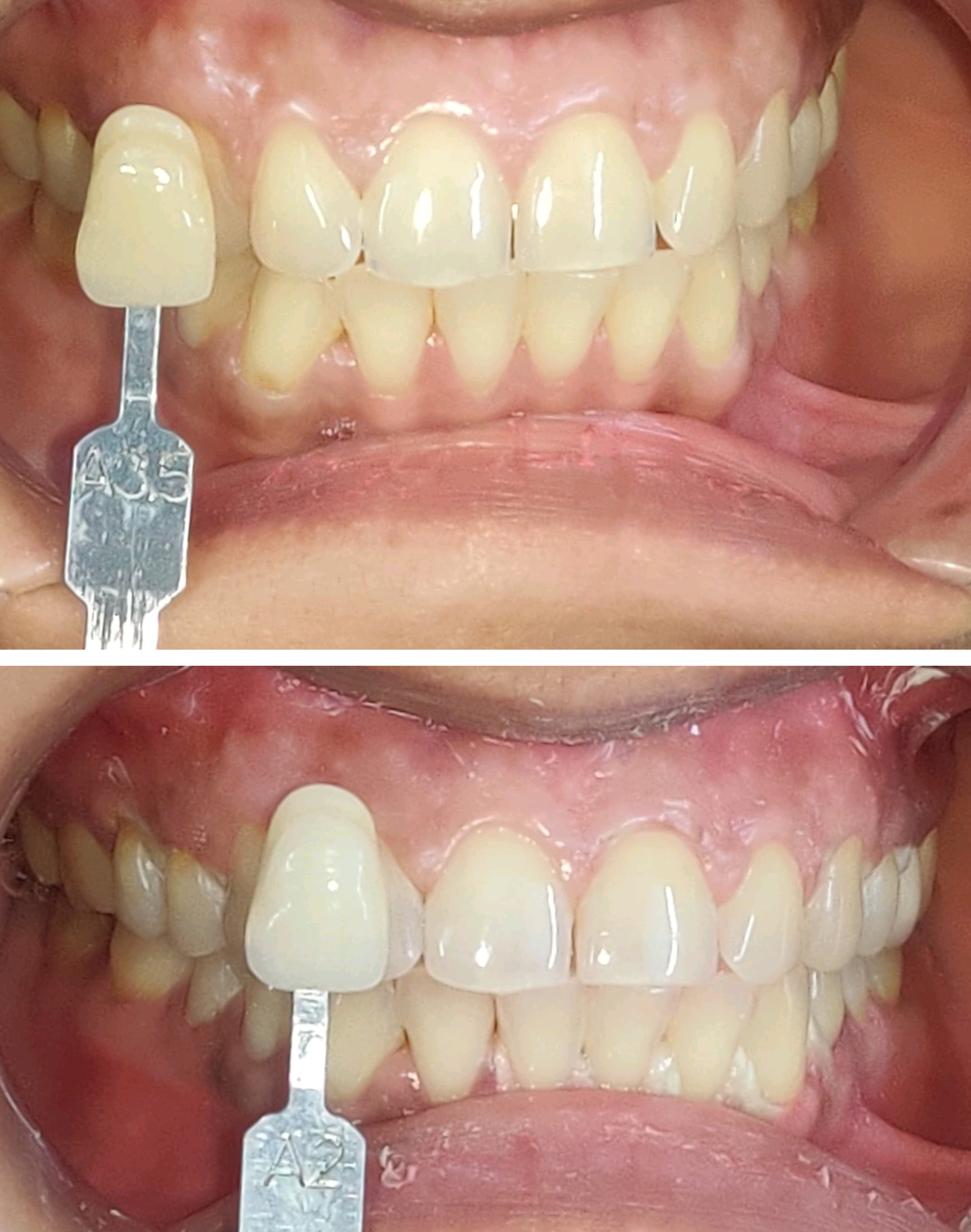 worried about yellow teeth that hamper your smi... main image