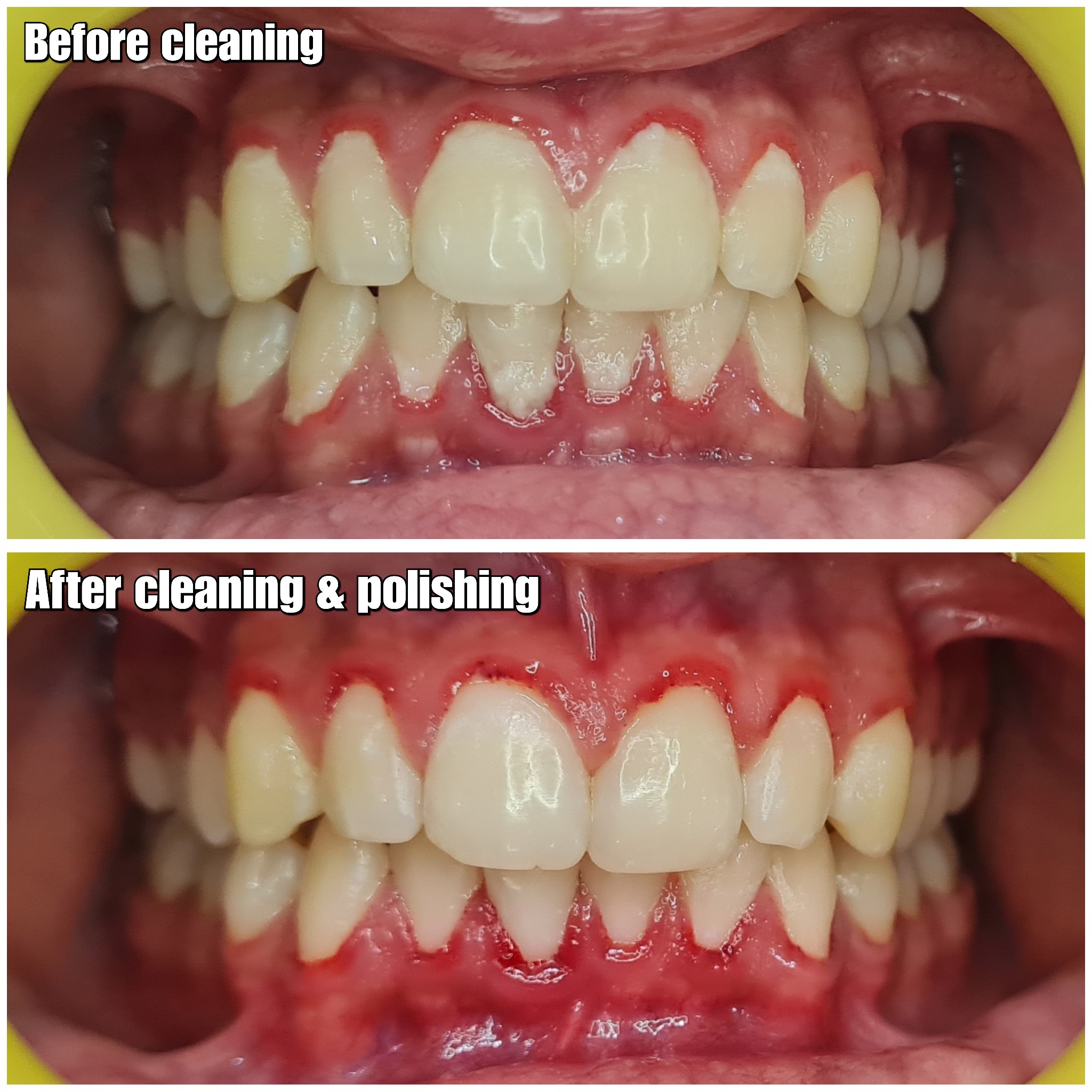 Dirty teeth contain food debris that harbour a ... main image