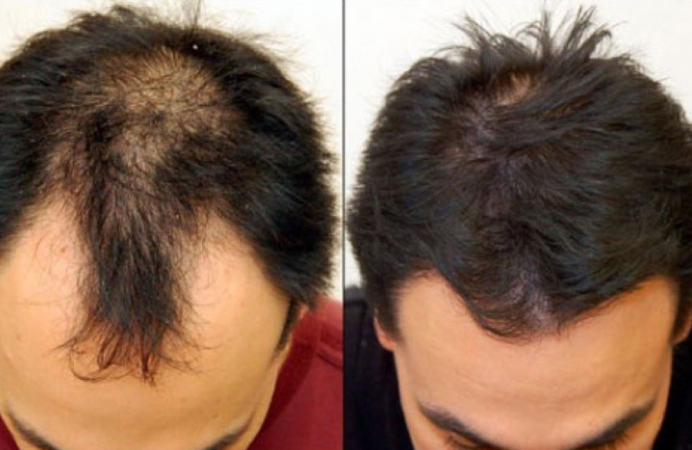 Best Hair Transplant Services for Men and Women in... main image