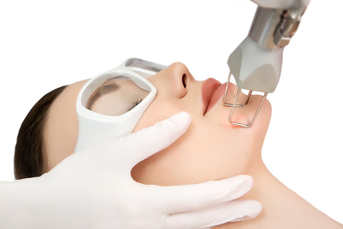 CO2 LASER AT VADAPALANI CO2 laser treatment is ... main image