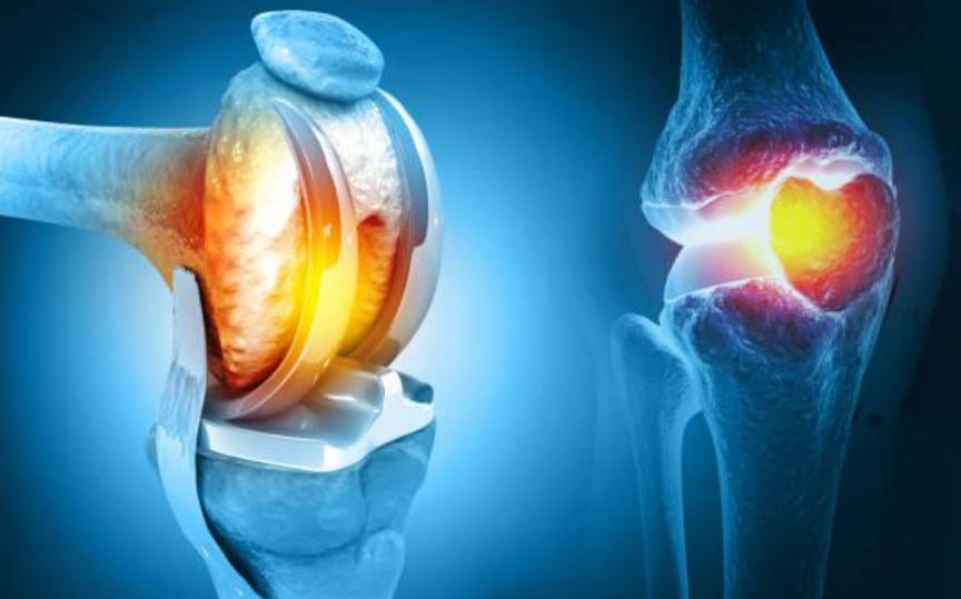 Knee Replacement Expertise at KC Hospital Knee ... main image