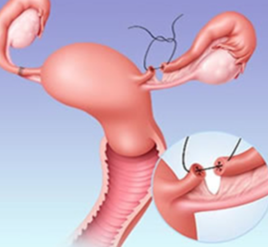 Safe and Reliable Laparoscopic Sterilization for W... main image