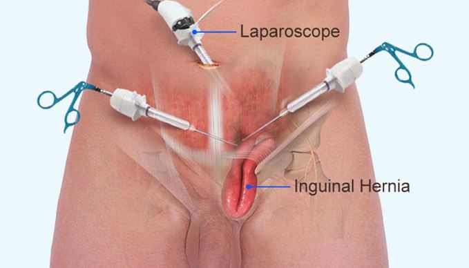 Minimally Invasive Hernia Surgery by Dr. Bineet... main image