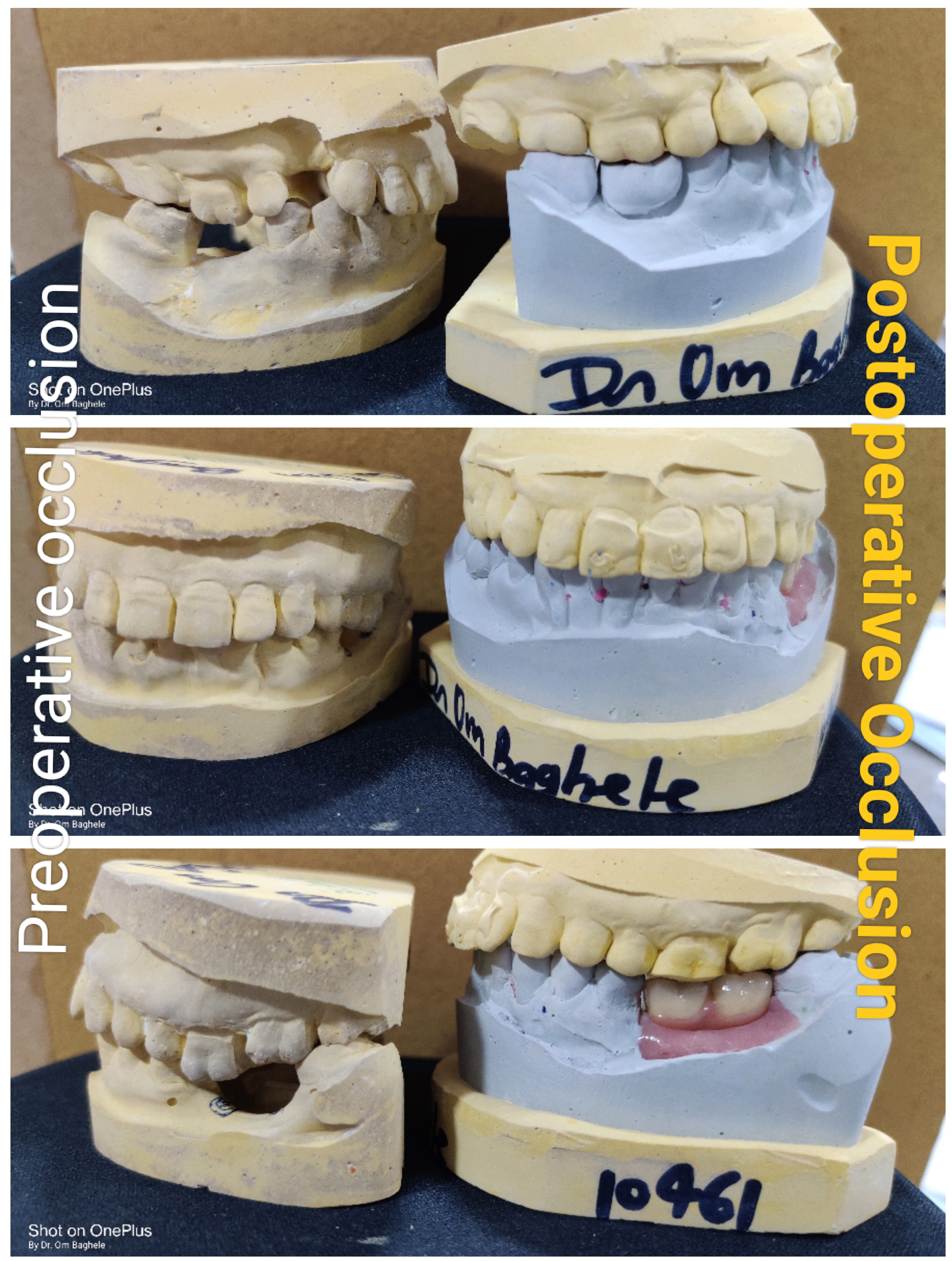 Occlusion or contact between the teeth, or how ... main image