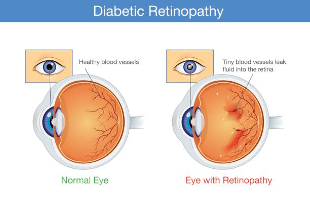 Managing Diabetic Retinopathy in Nagpur: Protec... main image