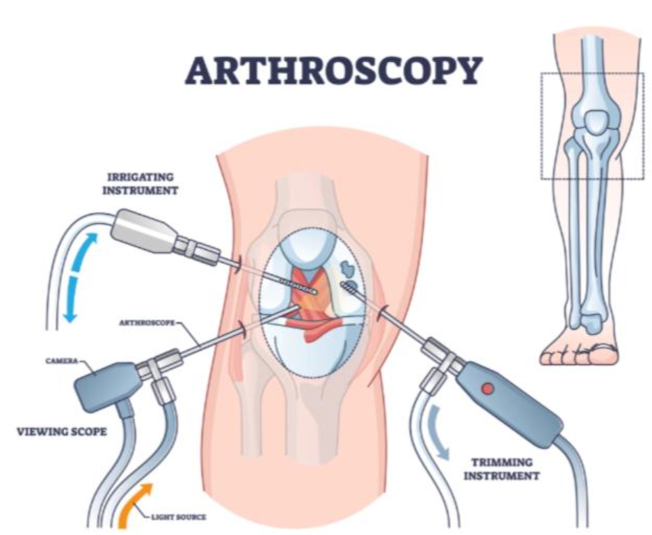 Arthroscopy for Minimally Invasive Joint Repair... main image