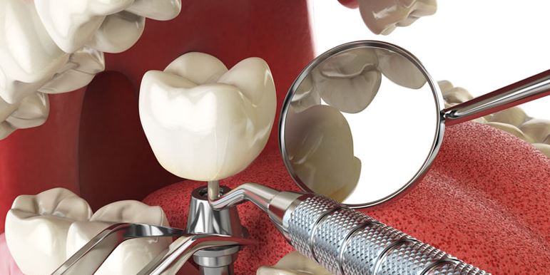 Implants Services in Nagpur Missing teeth can affe... main image