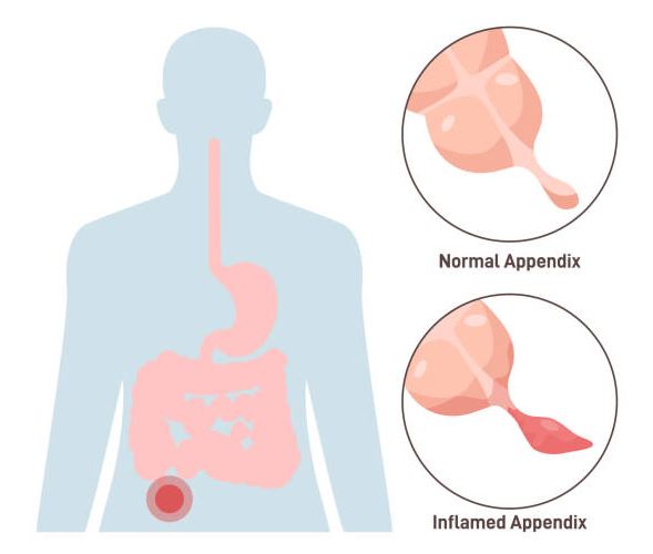 Specialized Appendix Surgeryin Mumbai Appendici... main image