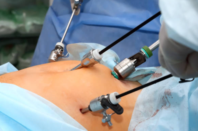 Laparoscopic Appendectomy: Quick Recovery for A... main image