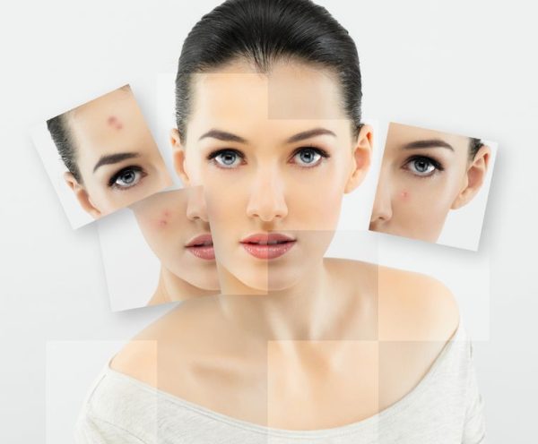 SKIN REJUVENATION AT ELORAA Skin rejuvenation t... main image