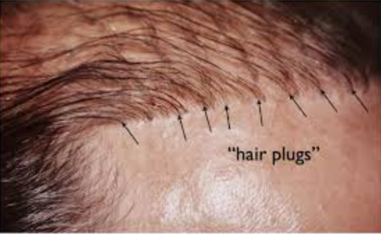 Hair Plugs: Modern Techniques at ELORAA CLINIQ Hai... main image