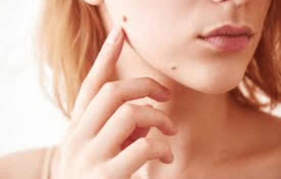 # Mole Removal Centre in Ulhasnagar 
# Mole Remova... main image