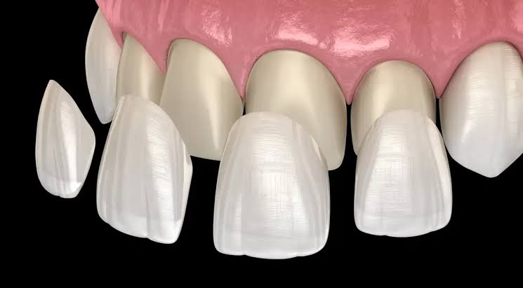 ⭐Dental Veneers at Paras Dental Care⭐

✨Dental ... main image