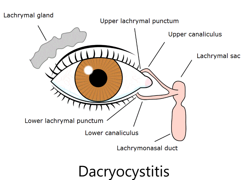 Dacryocystitis Treatment in Nagpur: Relief for ... main image