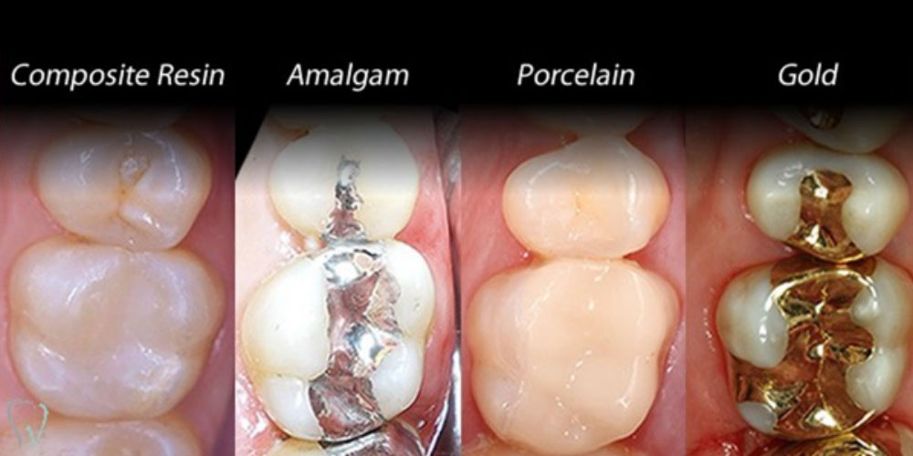 Key Points About Dental Fillings-
Purpose: To r... main image