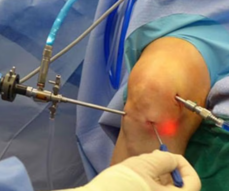 Keyhole Surgery: Precision with Minimal Recover... main image